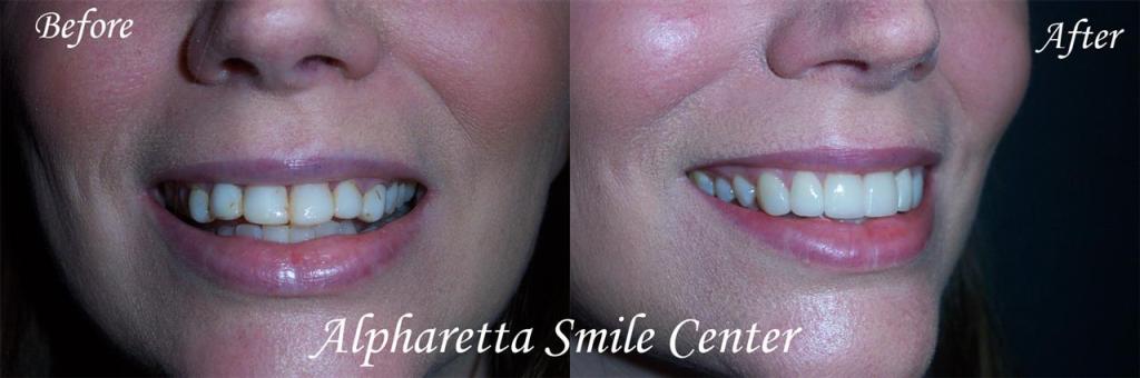 Porcelain veneers before and after