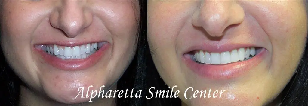 An uneven smile due to crooked teeth corrected by bonding and invisalign