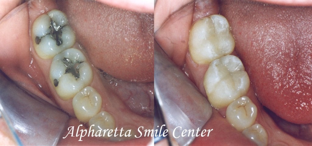 Tooth Fillings Alpharetta GA, Cosmetic Dentistry