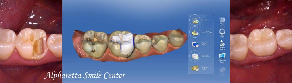 CEREC images of teeth