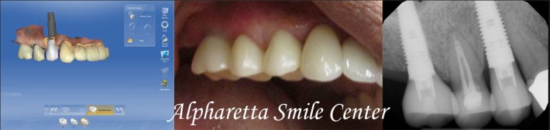 dental implants shown by computer, mouth, and x-ray