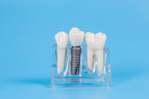 Model of a dental implant