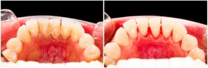 Before and after of periodontal maintenance 