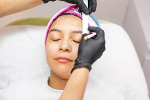 Woman receiving filler treatment on forehead